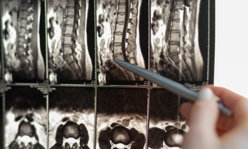 Image is of an xray of a spinal cord concept of a Winston Salem spinal cord injury lawyer