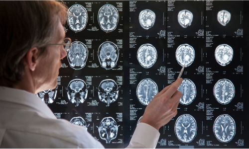 Image is of an mri brain scan concept of Winston Salem traumatic brain injury lawyer